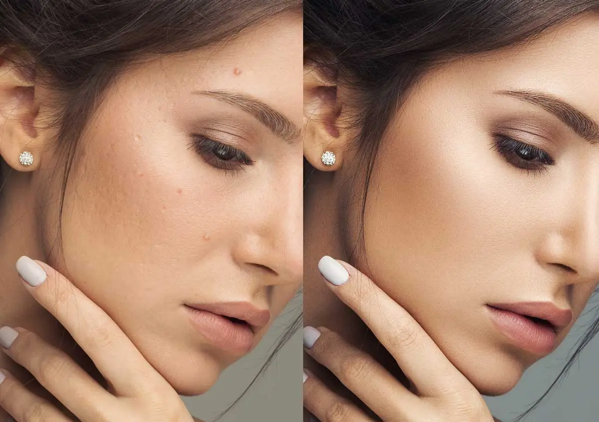 IPL-Photofacial-before-and-after-results