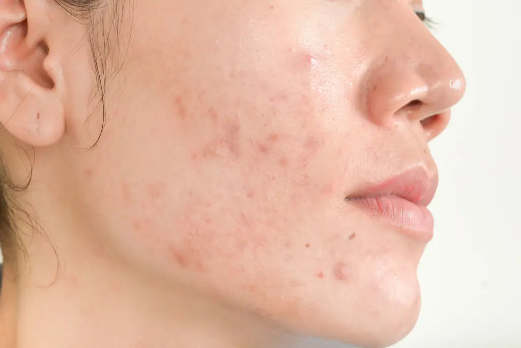 scar-from-acne-face2.jpg